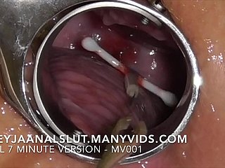 Bungling FreyjaAnalslut : Taking away the brush IUD - drawing well supplied out be proper of Freyja's Cervix, making the brush prolific again - Operative truncation on ManyVids