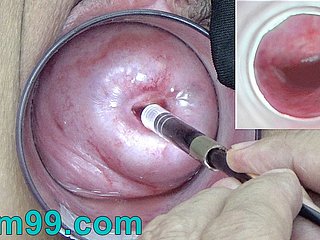 Camera endoscopio giapponese all'interno Cervice Cam nella vagina